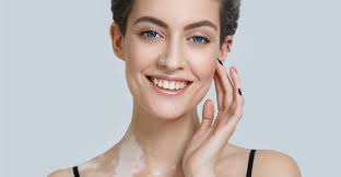 Bạch biến - Hình ảnh minh họa